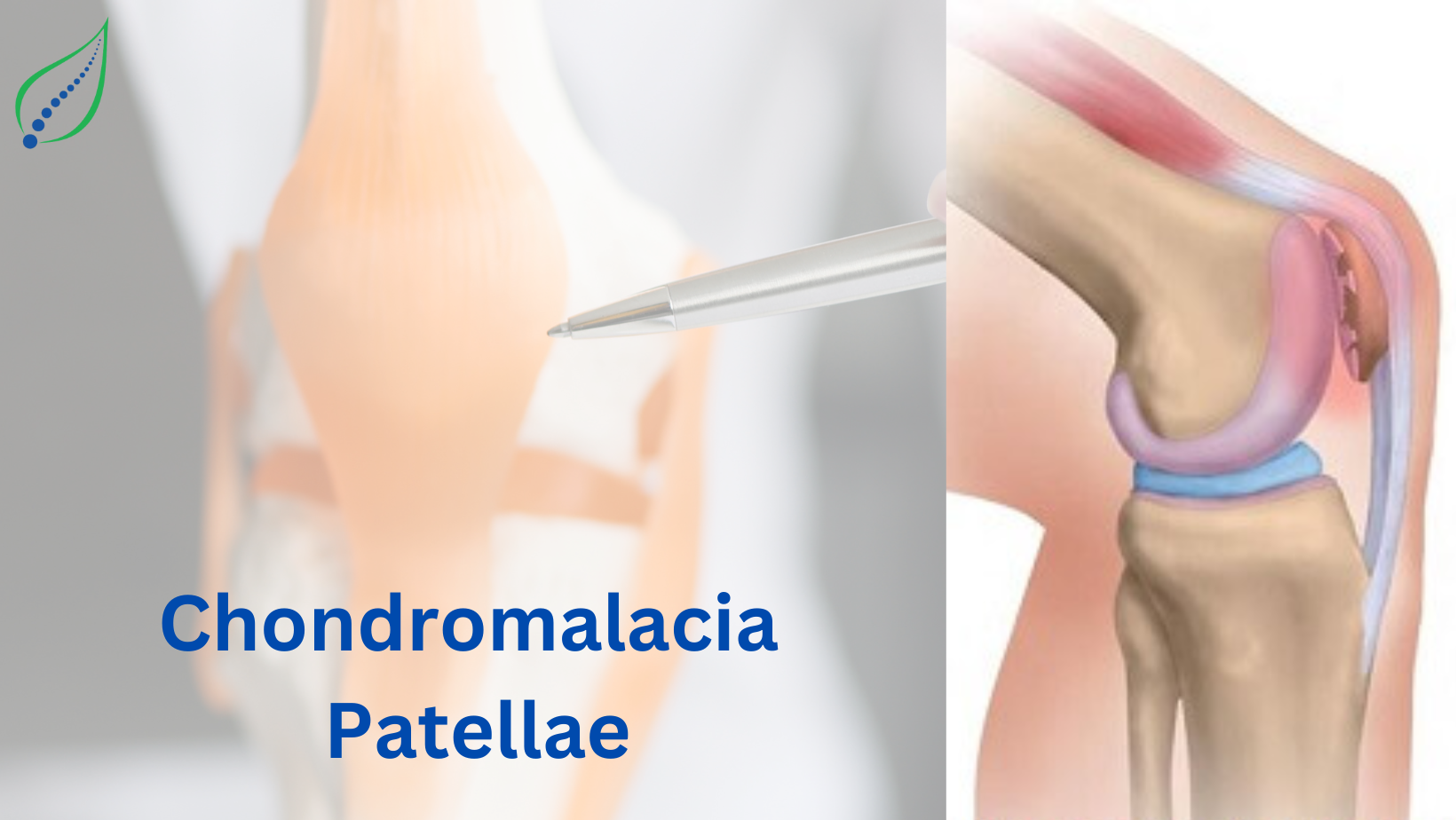 Chondromalacia Patellae