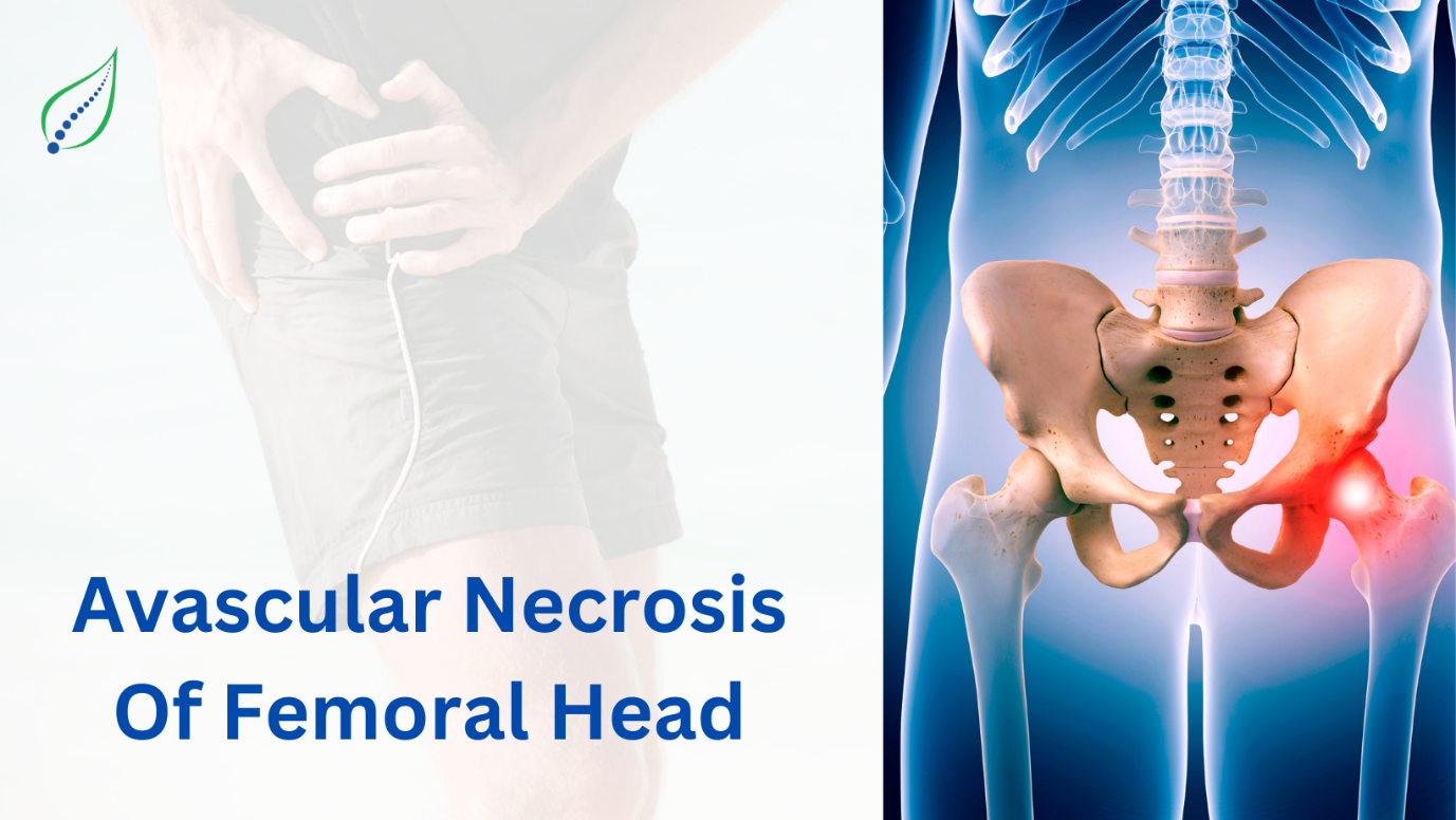 Avascular Necrosis Of Femoral Head