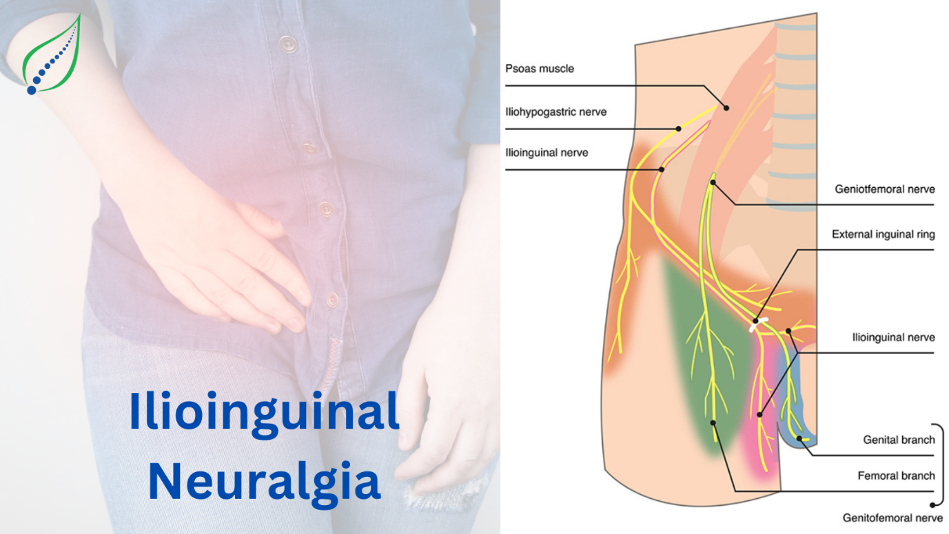 Ilioinguinal Neuralgia