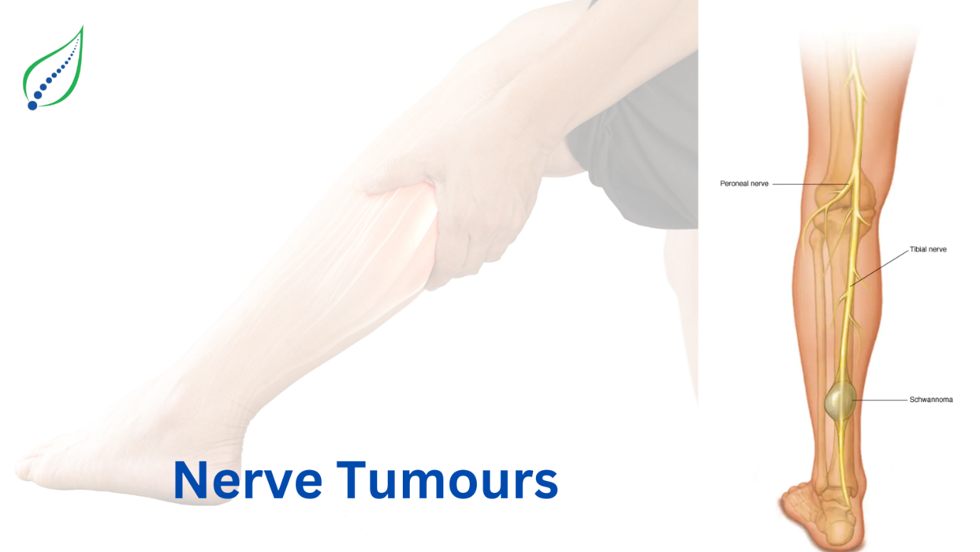 Nerve Tumour