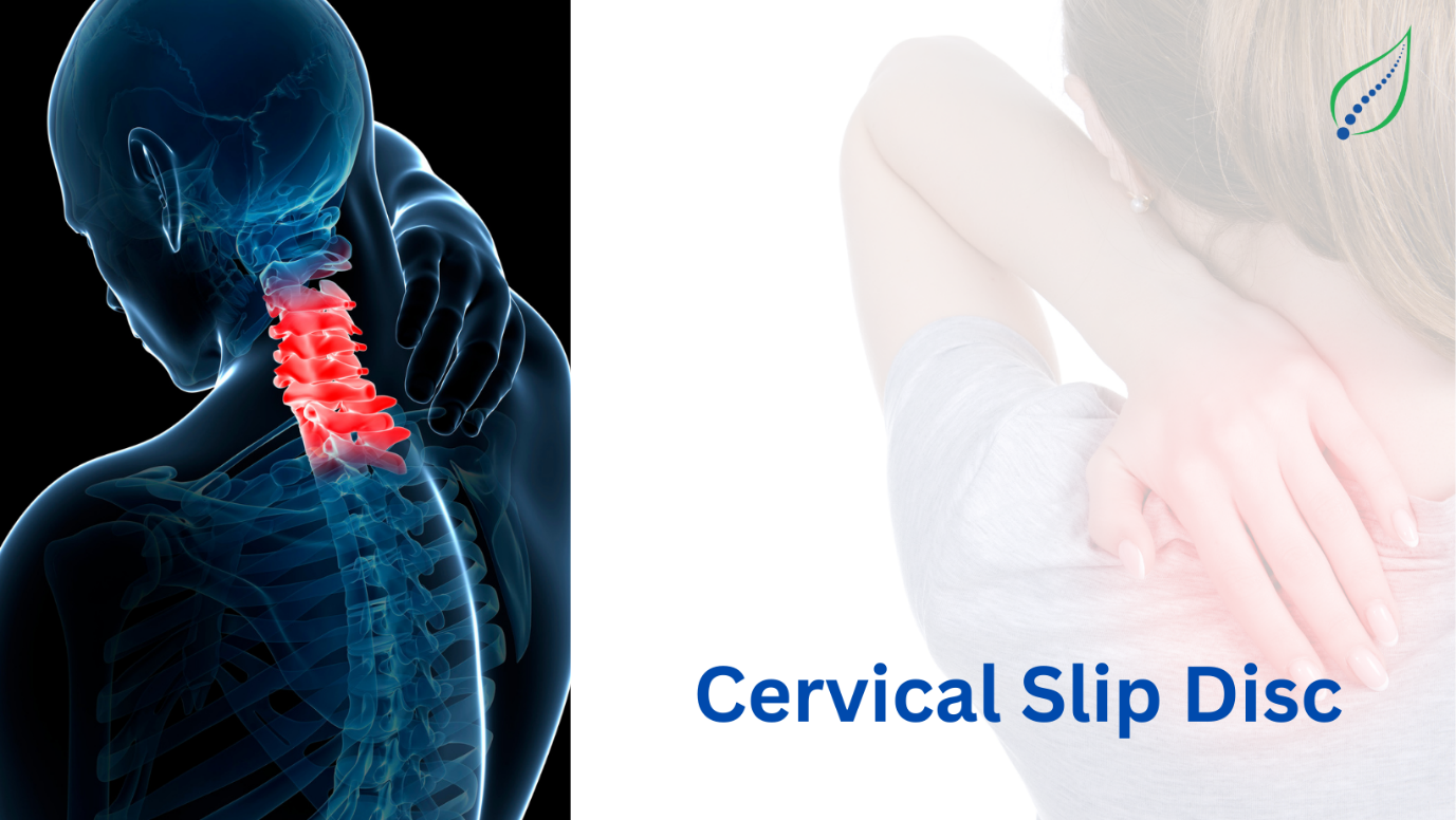 Cervical Slip Disc