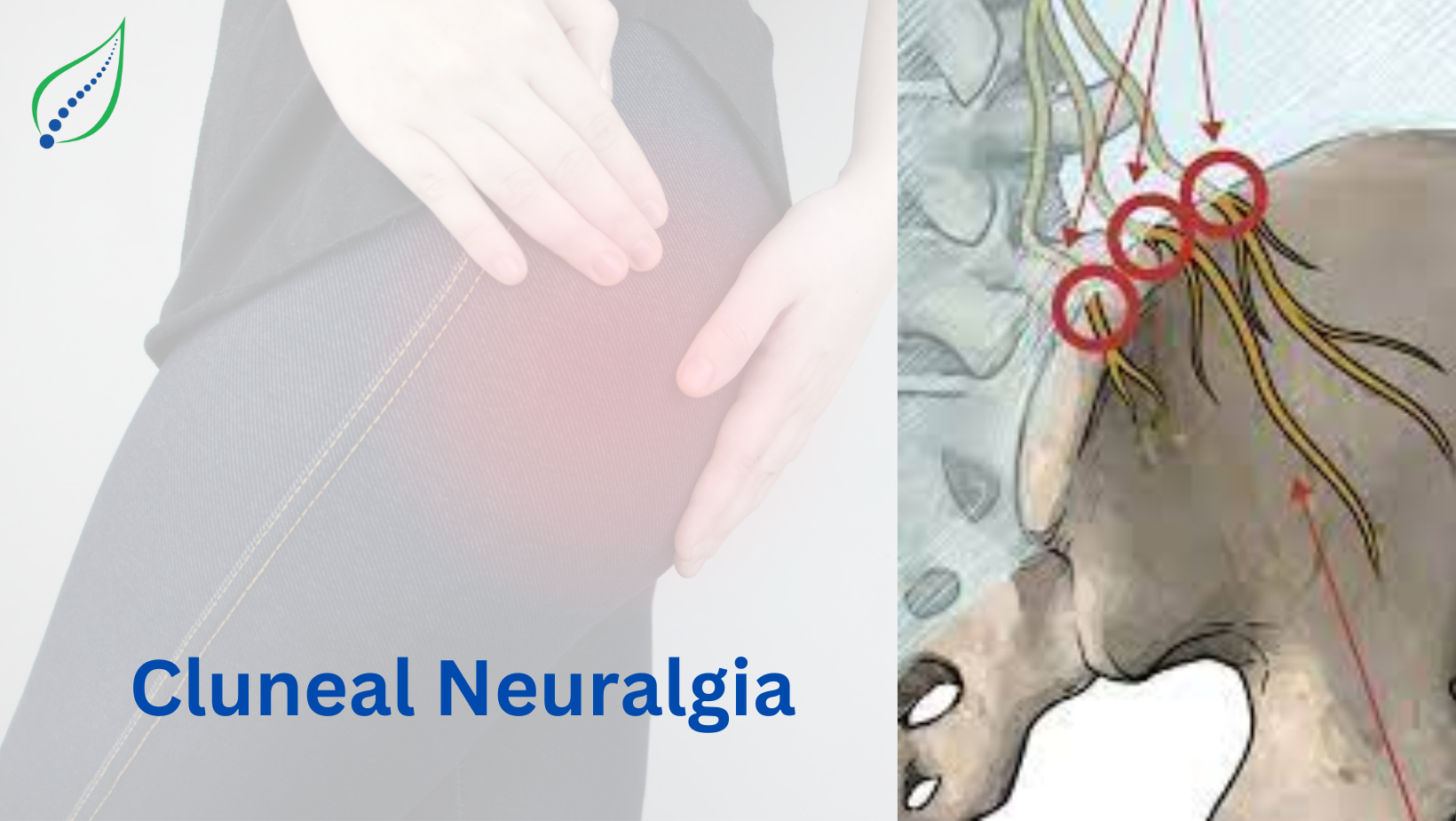 Cluneal Neuralgia