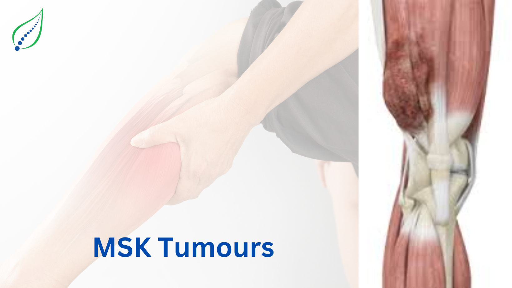 MSK Tumors