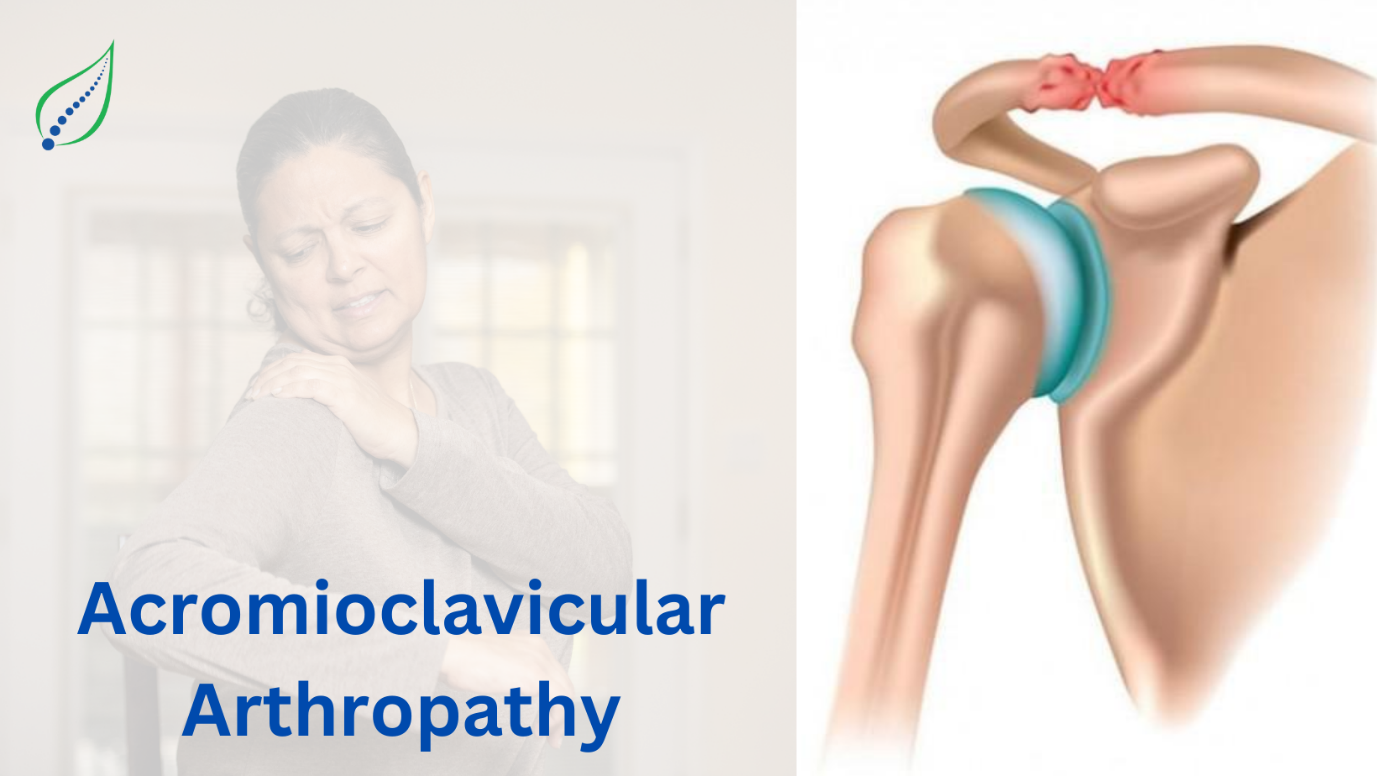 Acromioclavicular Arthropathy