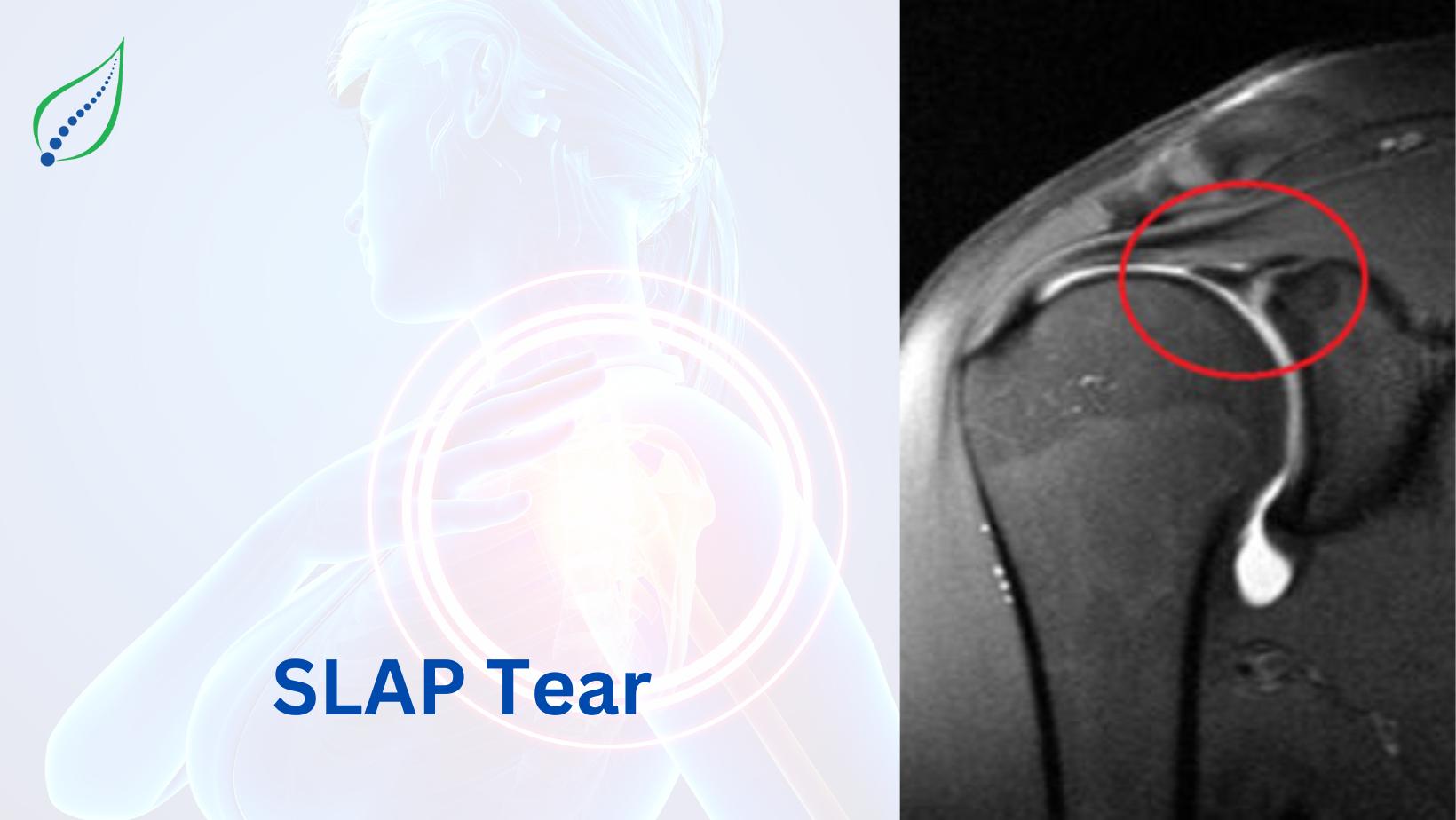 SLAP Tear