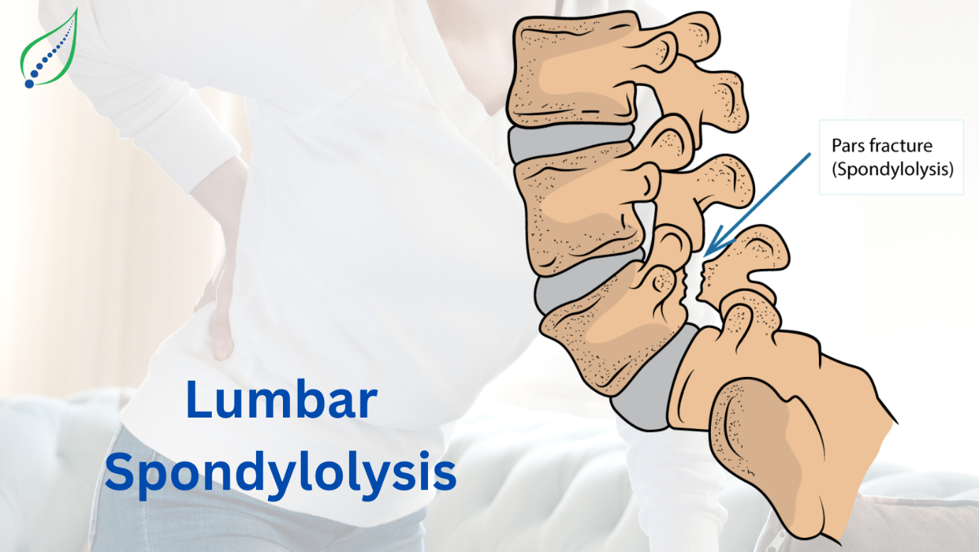 Lumbar Spondylolysis