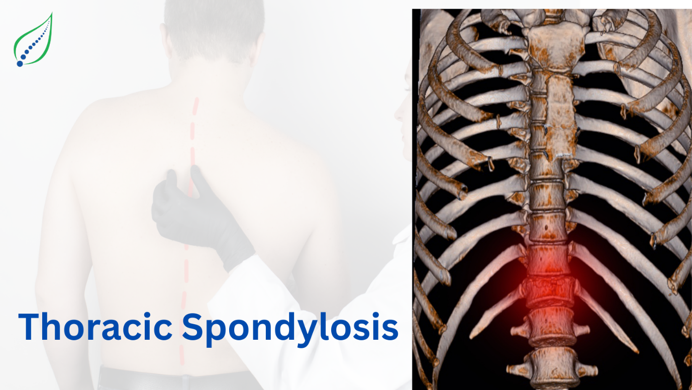 Thoracic Spondylosis